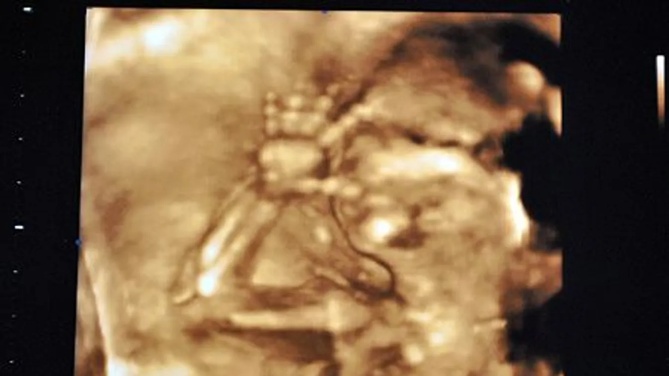 Teljes abortusztilalom lesz Magyarországon?