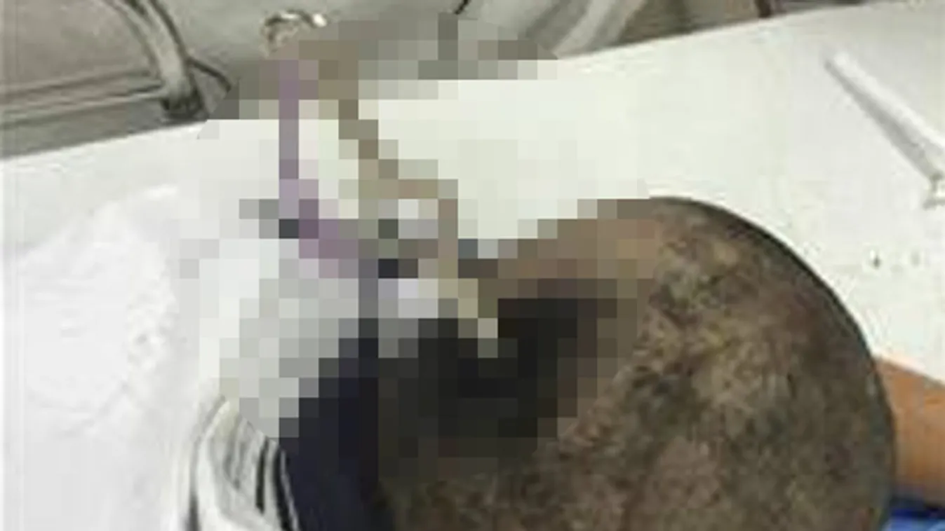 Óriási szerencsének köszönheti az életét a fejbe szúrt kislány