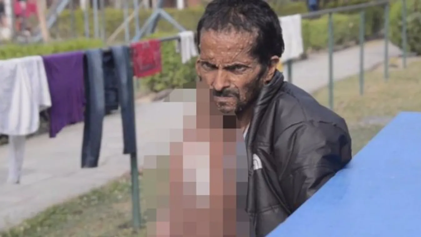 Kisgyermek súlyú tumort műtöttek le a férfi arcáról - 18+ videó