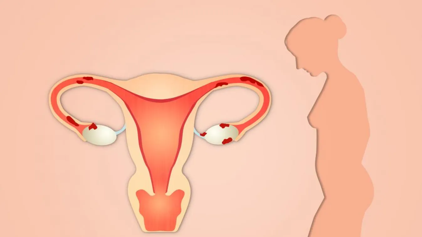 Endometriózis: tíz százalék esélyt adtak, hogy lesz gyerekem