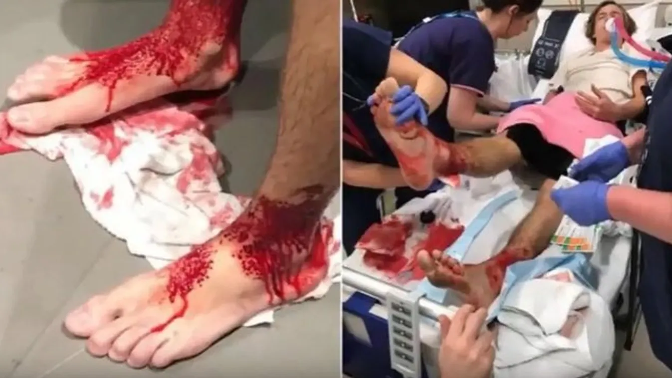 A tengerbe lógatta a lábát, rejtély, mi kezdte lerágni a lábfejét - fotó
