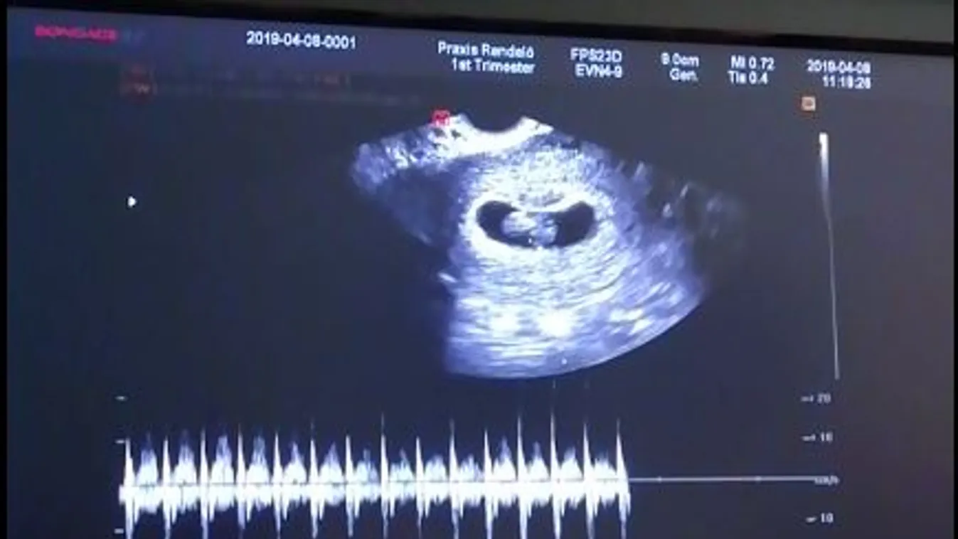 Zokogva léptem ki az ultrahangrendelő ajtaján