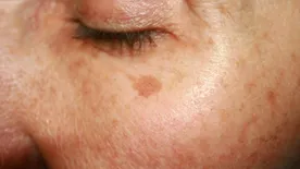 Tudta? Ezért alakulnak ki a pigmentfoltok