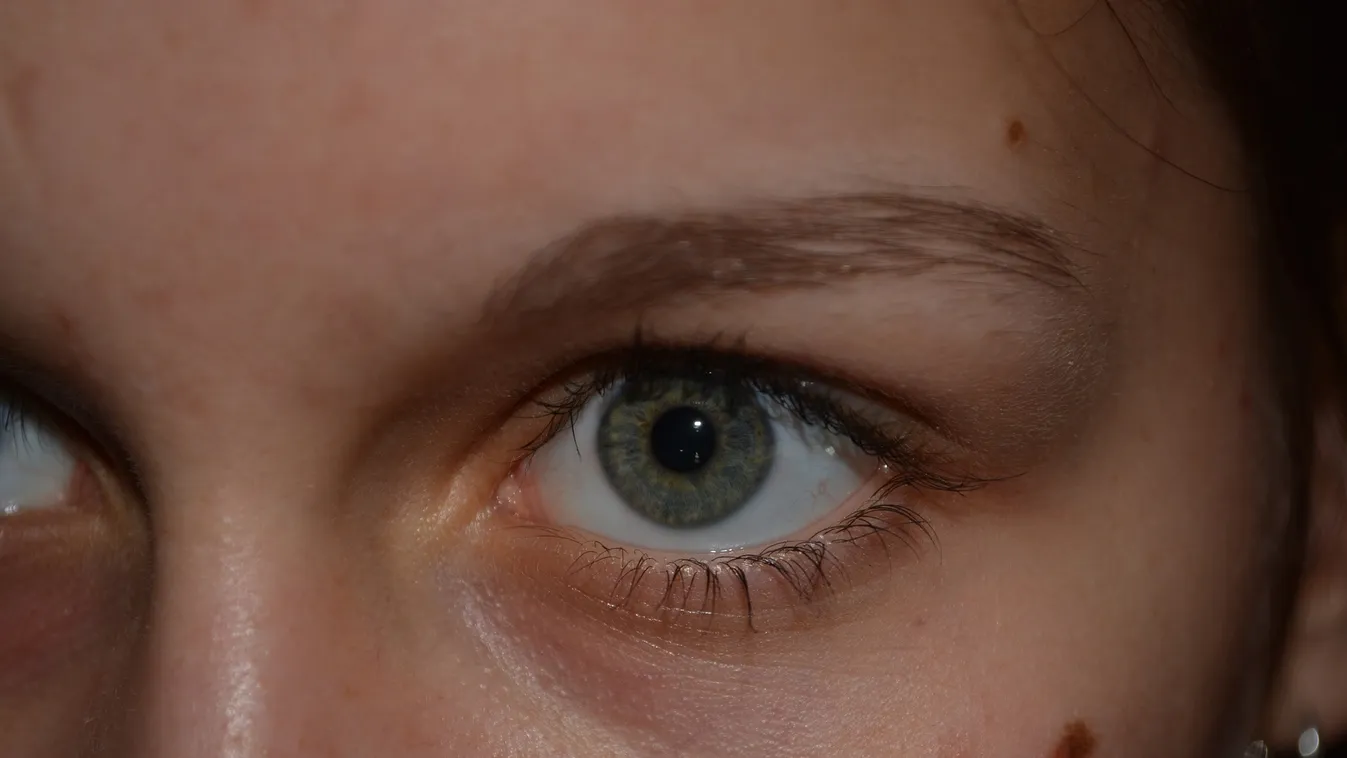 Anyajegy vagy melanoma?