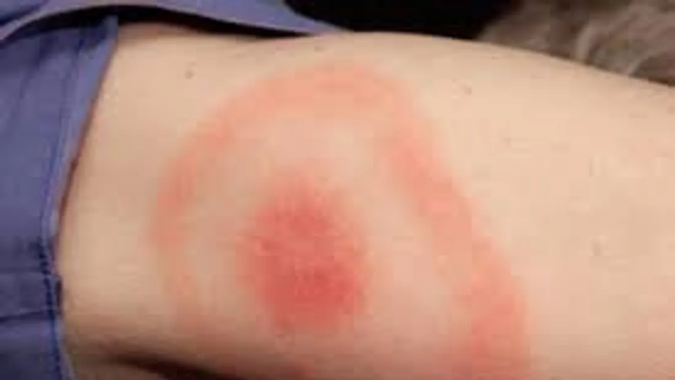 Lyme-kóros lett a másfél éves kisfiam