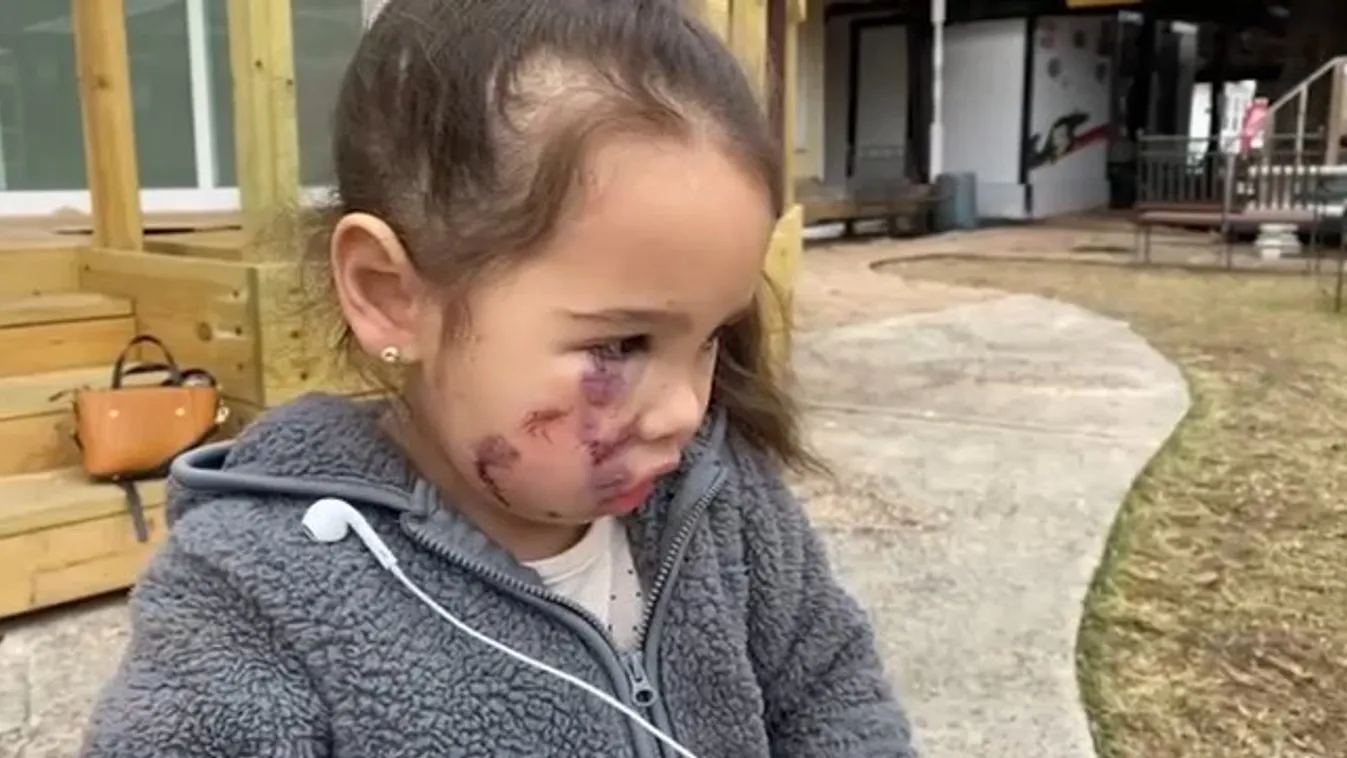 Ki a felelős ezért? Egy étteremben tépte szét a kislány arcát egy kutya