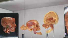 Videó készült az egyedülálló emberipreparátum-gyűjteményről