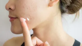 Döbbenet: kinyomott egy pattanást az állán, az intenzív osztályon kötött ki