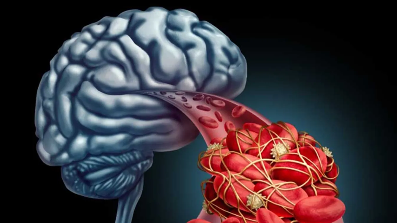Új stroke-központ nyílik Budapesten