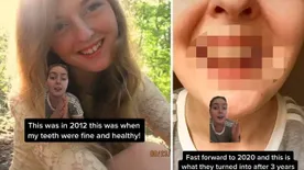 Undorító, mit tettek a cukros üdítők ennek a fiatal nőnek a fogaival röpke 10 év alatt – videó