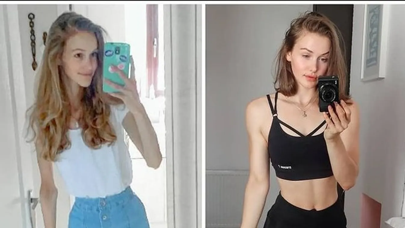 Csodálatos átváltozás - Nagyon súlyos anorexiából épült fel a fiatal lány
