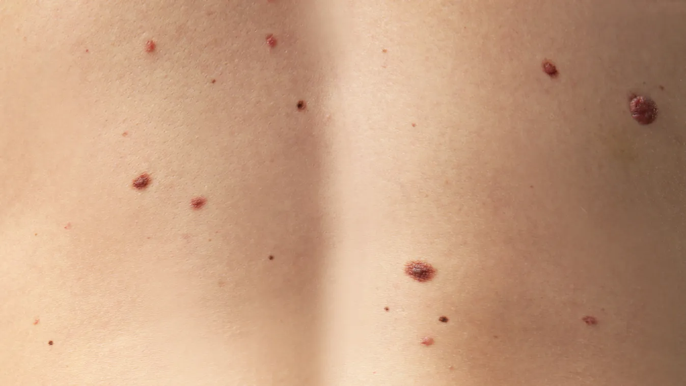 Kiemelkedő, kékes-fekete csomó a noduláris melanoma