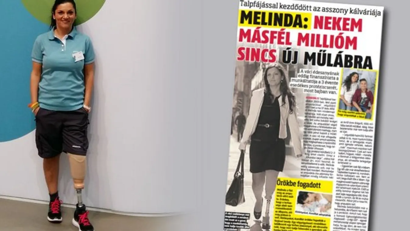 Sztárok hakniznak Melinda műlábáért