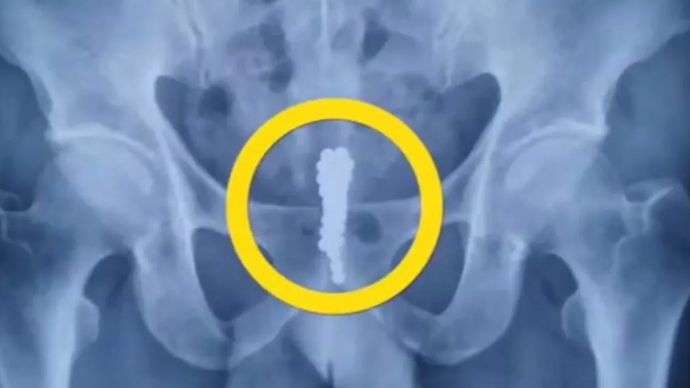 Egy páciense röntgenfelvételt vizsgálva sokkot kapott a háziorvosa - senki sem érti, mit is látnak a képen - videó