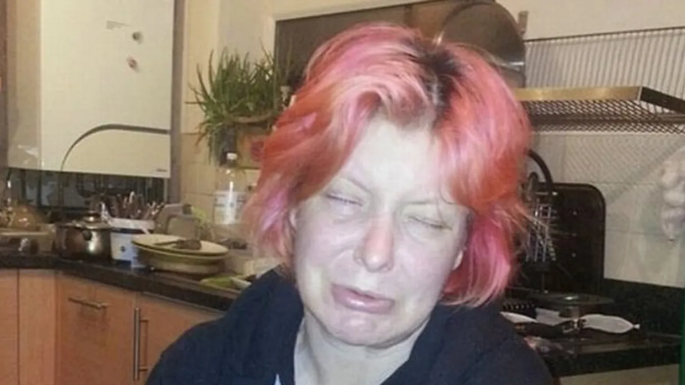 30 éve nem tud mosolyogni egy ritka betegség miatt