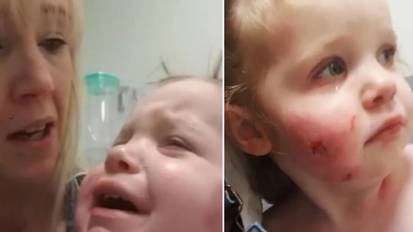 Egy életen keresztül viseli majd a sebhelyeket a kislány, akit egy játszóházban támadtak meg - videó