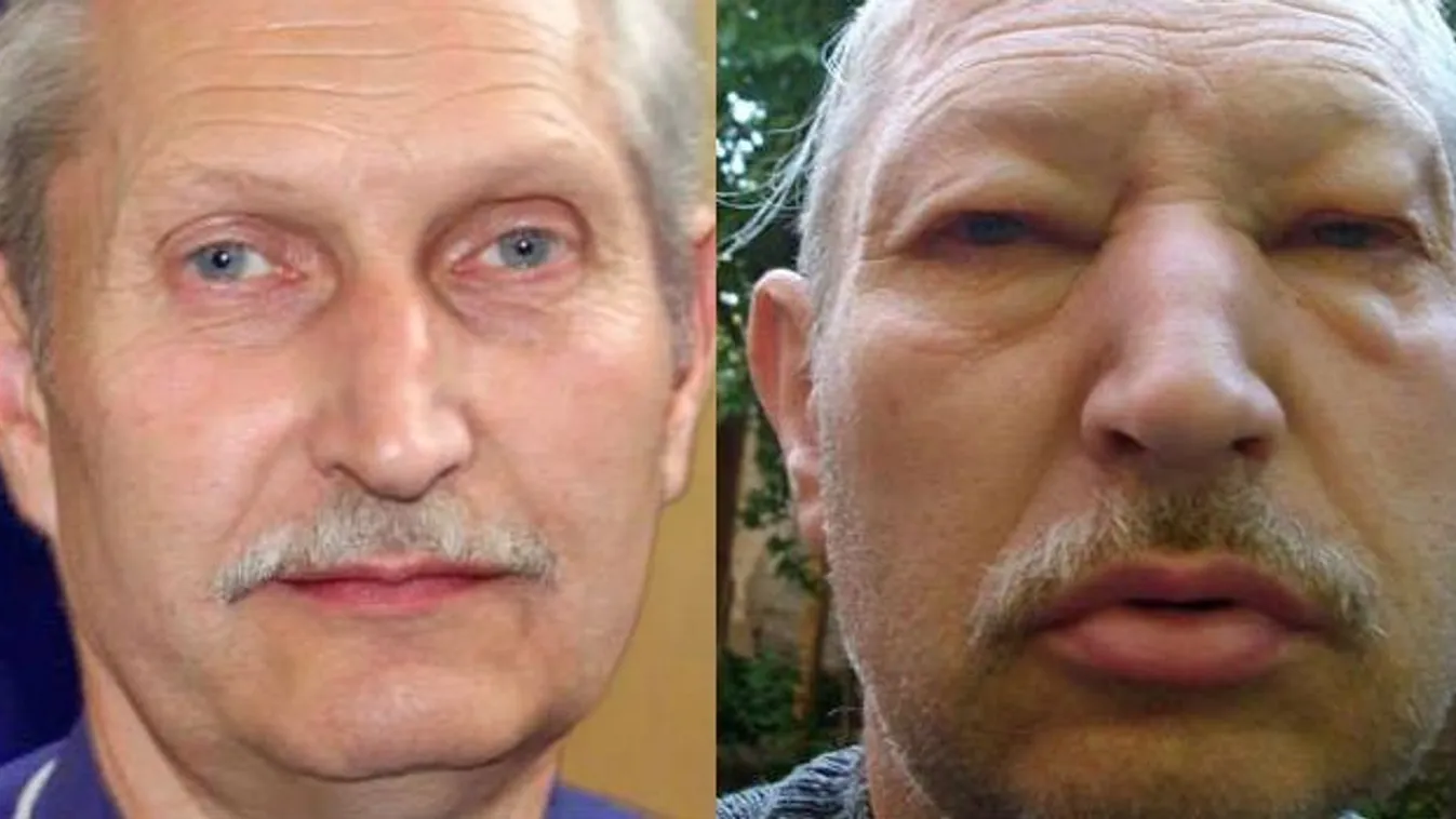 Rutinműtéttől nőtt duplájára Zoltán arca