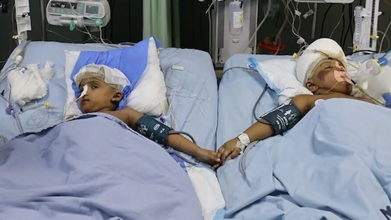 Tucatnyi műtétet kell még elvégezni a szétválasztott bangladesi sziámi ikreken