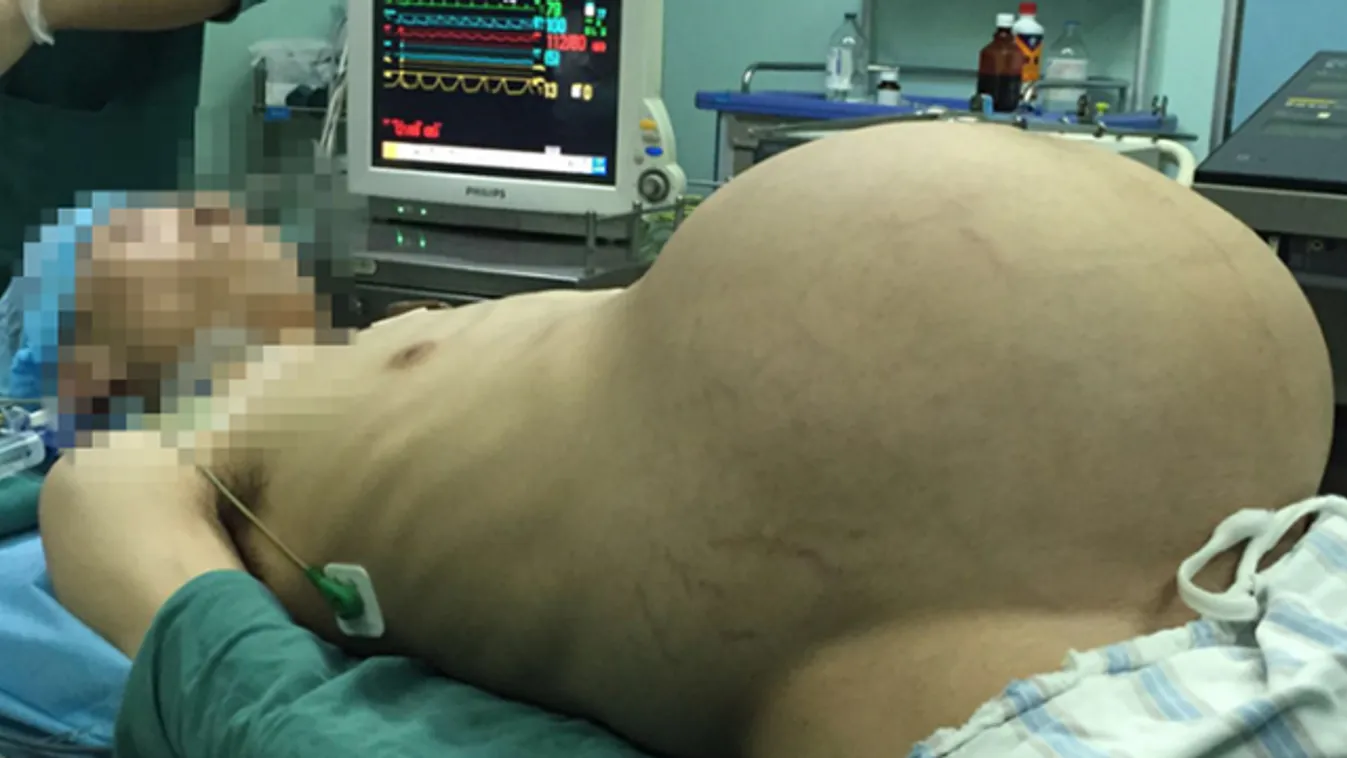 Szörnyű tumor nőtt a férfi hasában – durva fotók