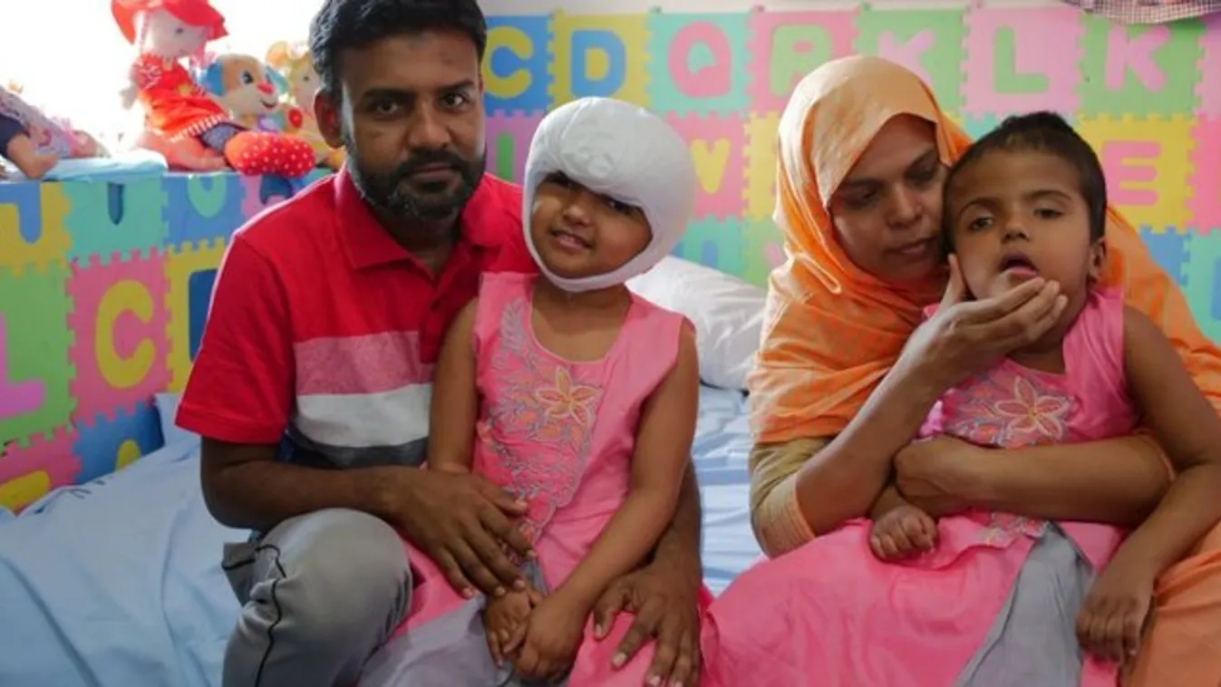 Szétválasztott bangladesi sziámi ikerpár: sürgősen meg kell műteniük a magyar orvosoknak Rabiát