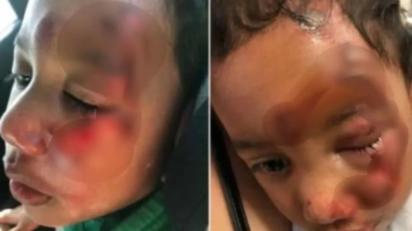 Csúnya fejsérülést szenvedett egy kerekesszékes kisfiú, de az ápolónői nem árulják el, hogyan 