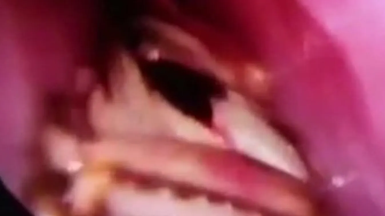 Horror: élő csótányt találtak egy nő koponyájában