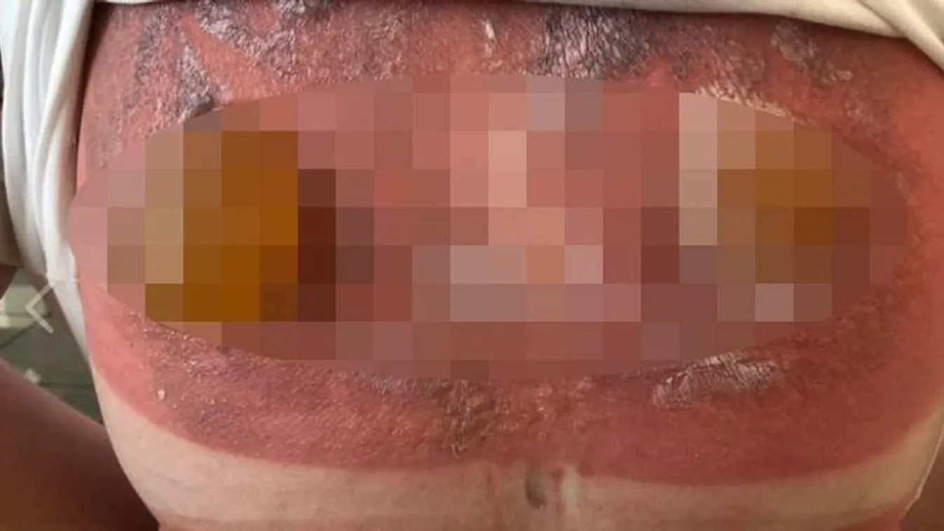 Hiába kente be magát naptejjel: horrorisztikus hólyagok nőttek a fiatal lány hátára – 18+ fotó