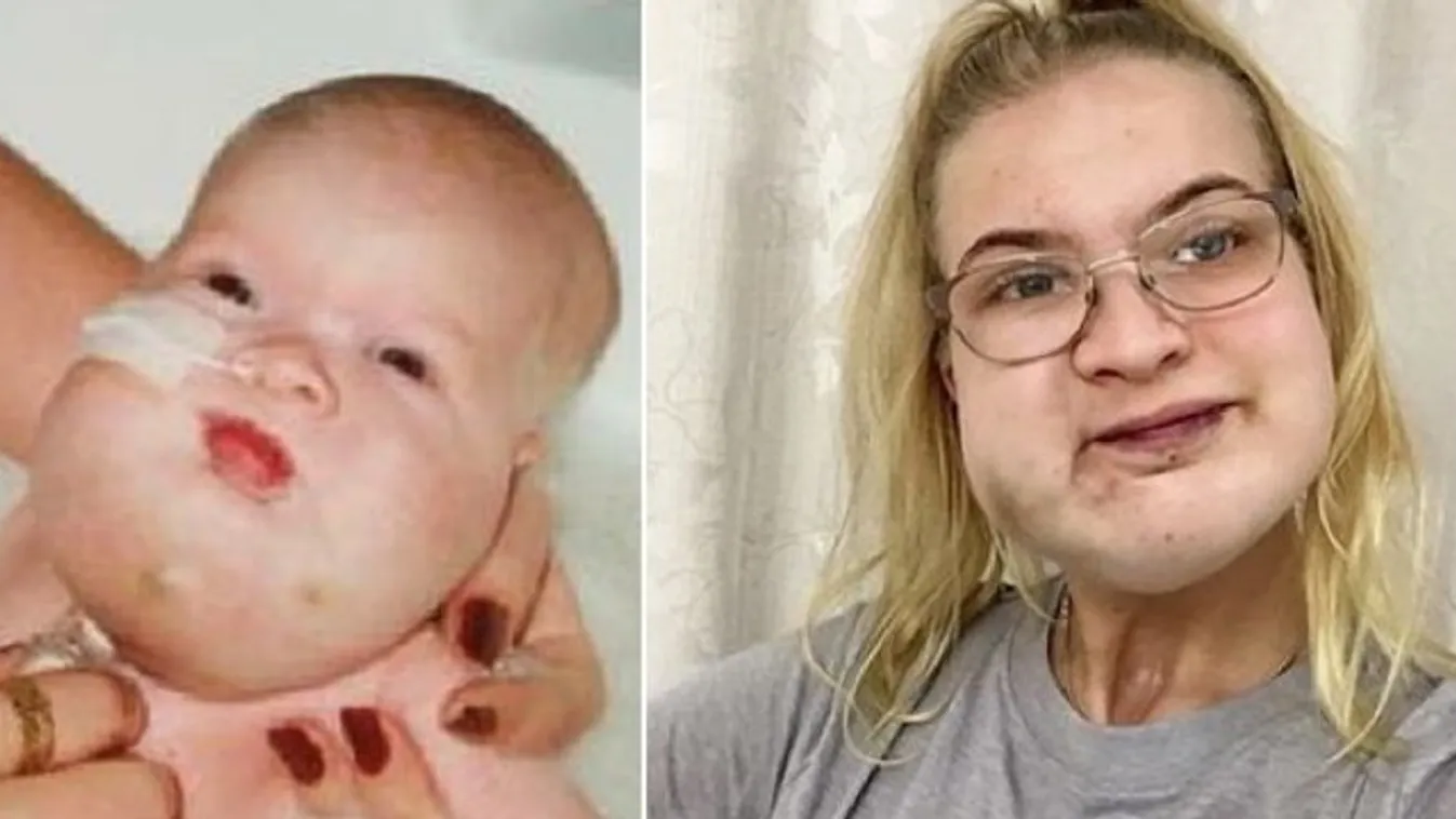 Hiába csúfolják gömbhalnak, a tini mostanra megtanulta szeretni az arcában növekvő tumort