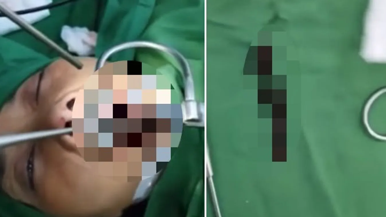 Hogy nem vették észre? Hónapokig élt a torkában egy piócával - videó