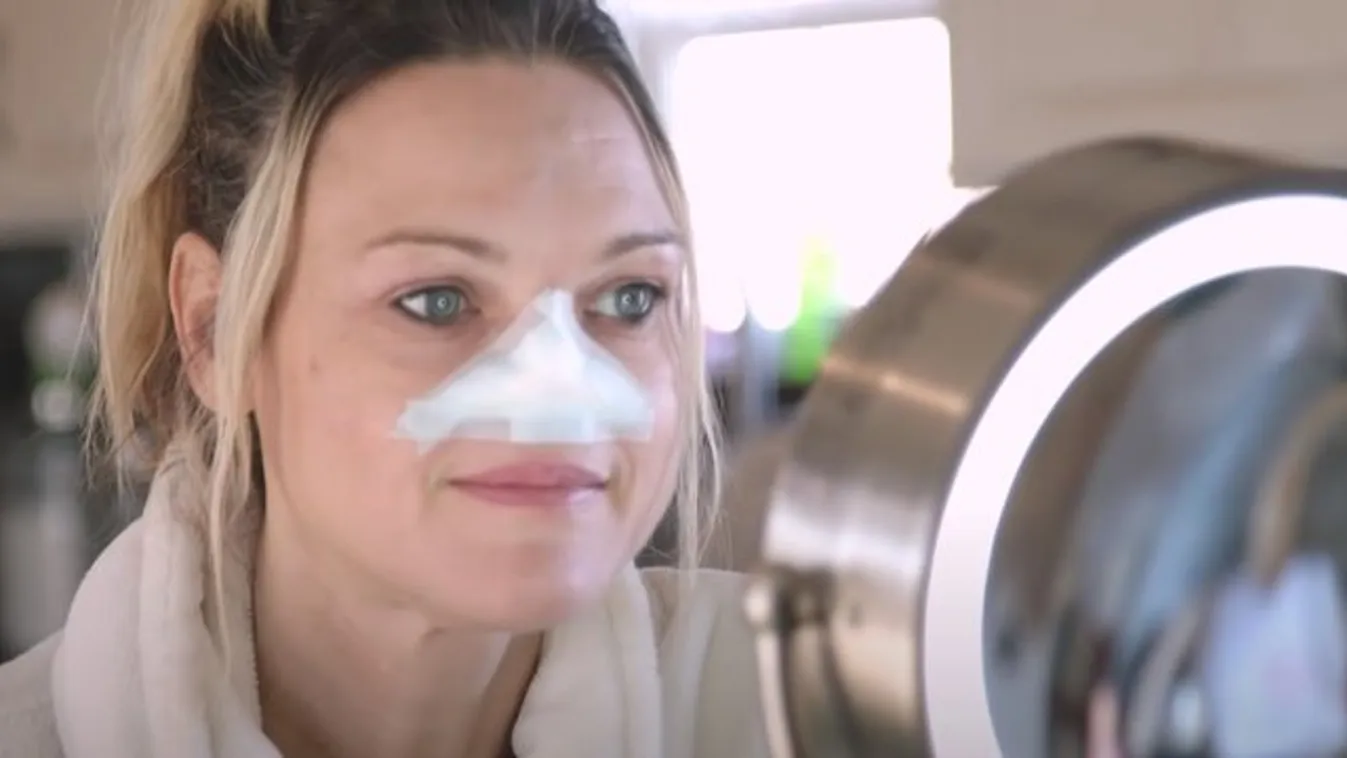 Elvette a rák az orrát, de ő gyönyörűbbnek érzi magát, mint valaha – videó