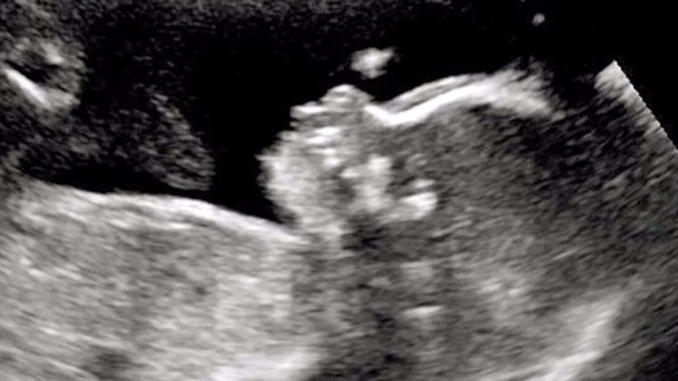 Elképesztő, mije látszódott a babának az ultrahang felvételen