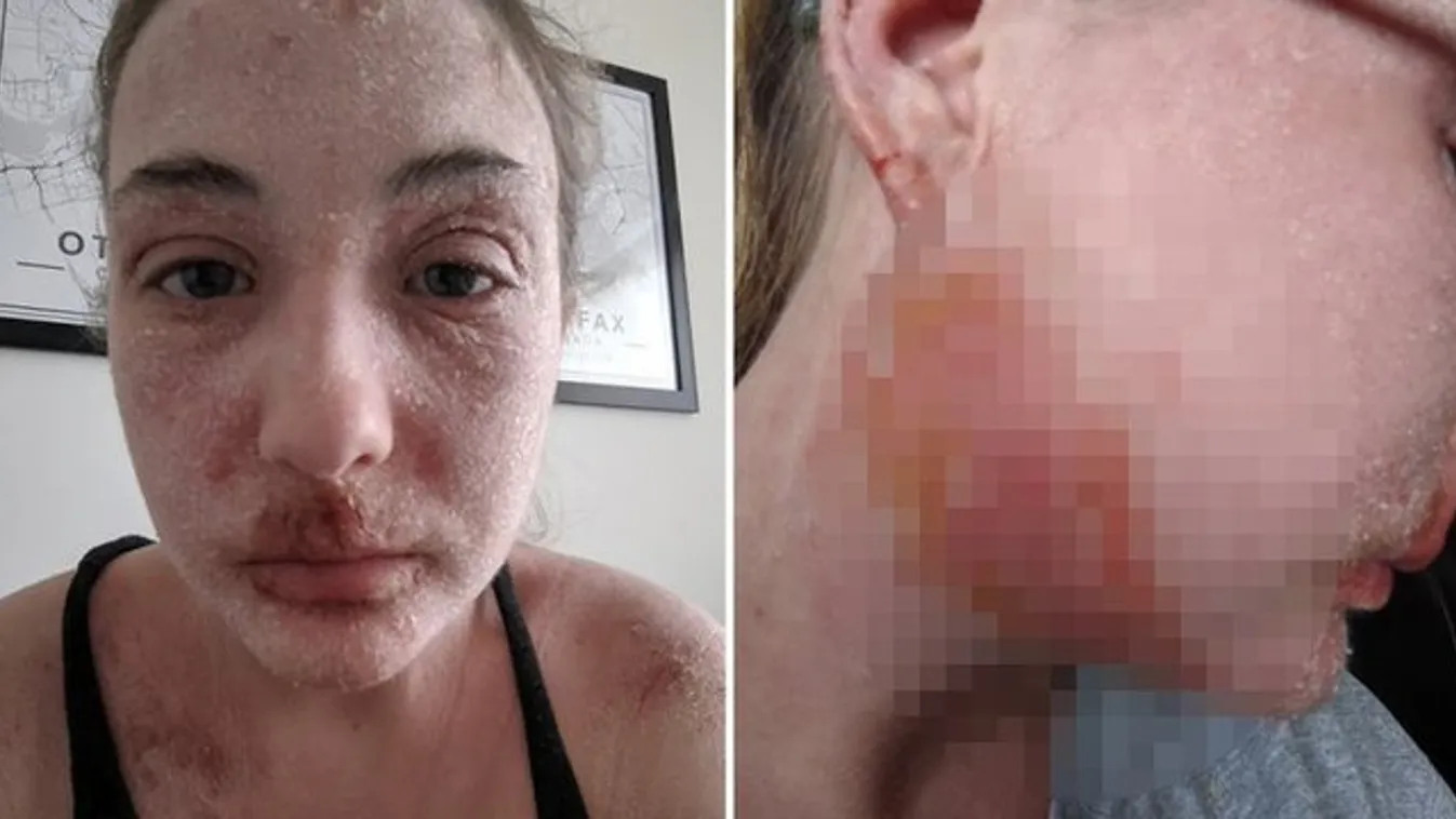Viszketni kezdett bőre, sokkoló dolog történt az egykor gyönyörű lány arcával - 18+