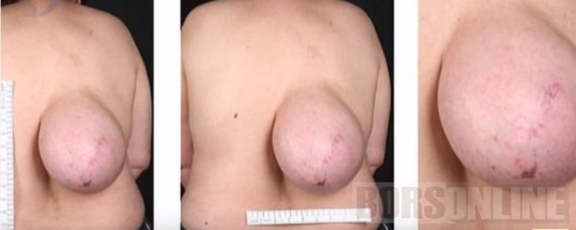 болезнь когда у мужчин грудь фото 95