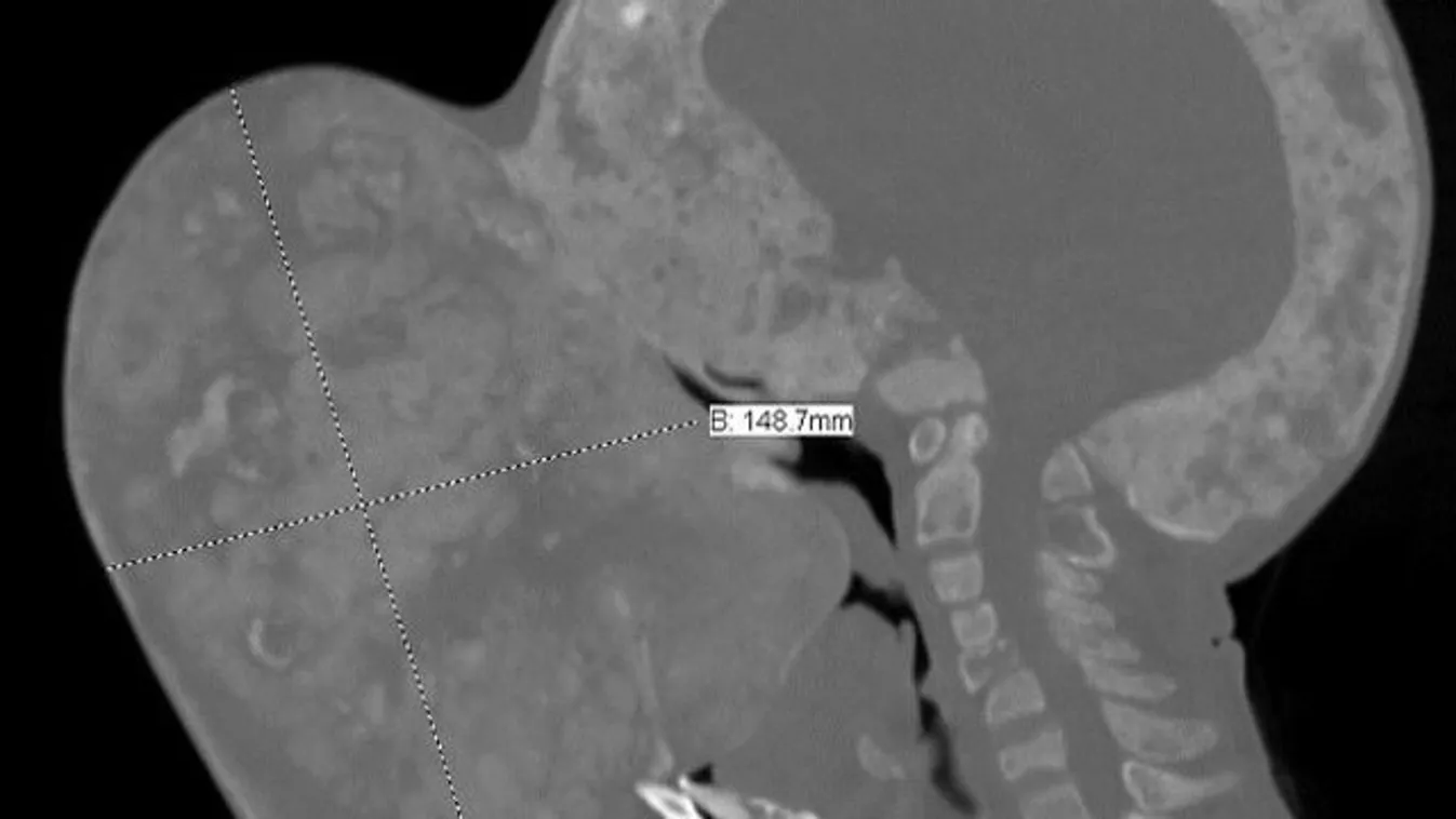 Leszedték az arcáról a daganatot, a tüdeje és a veséje viszont feladta