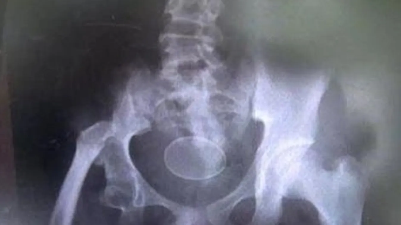 Az orvosok sem értik, hogy csinálja – Tojás tojással kábít az indonéz fiú – videó