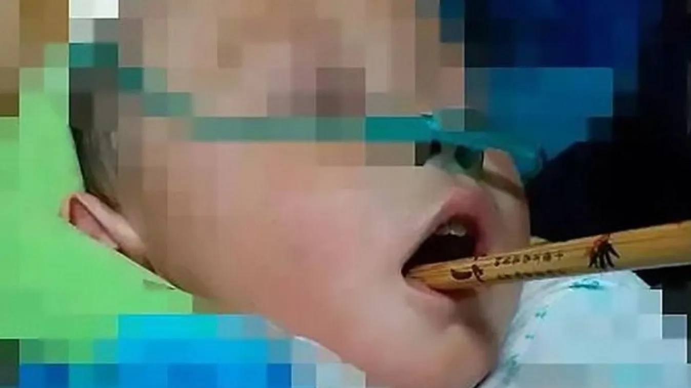 Miért ne rohangáljon senki evőpálcikával a szájában?