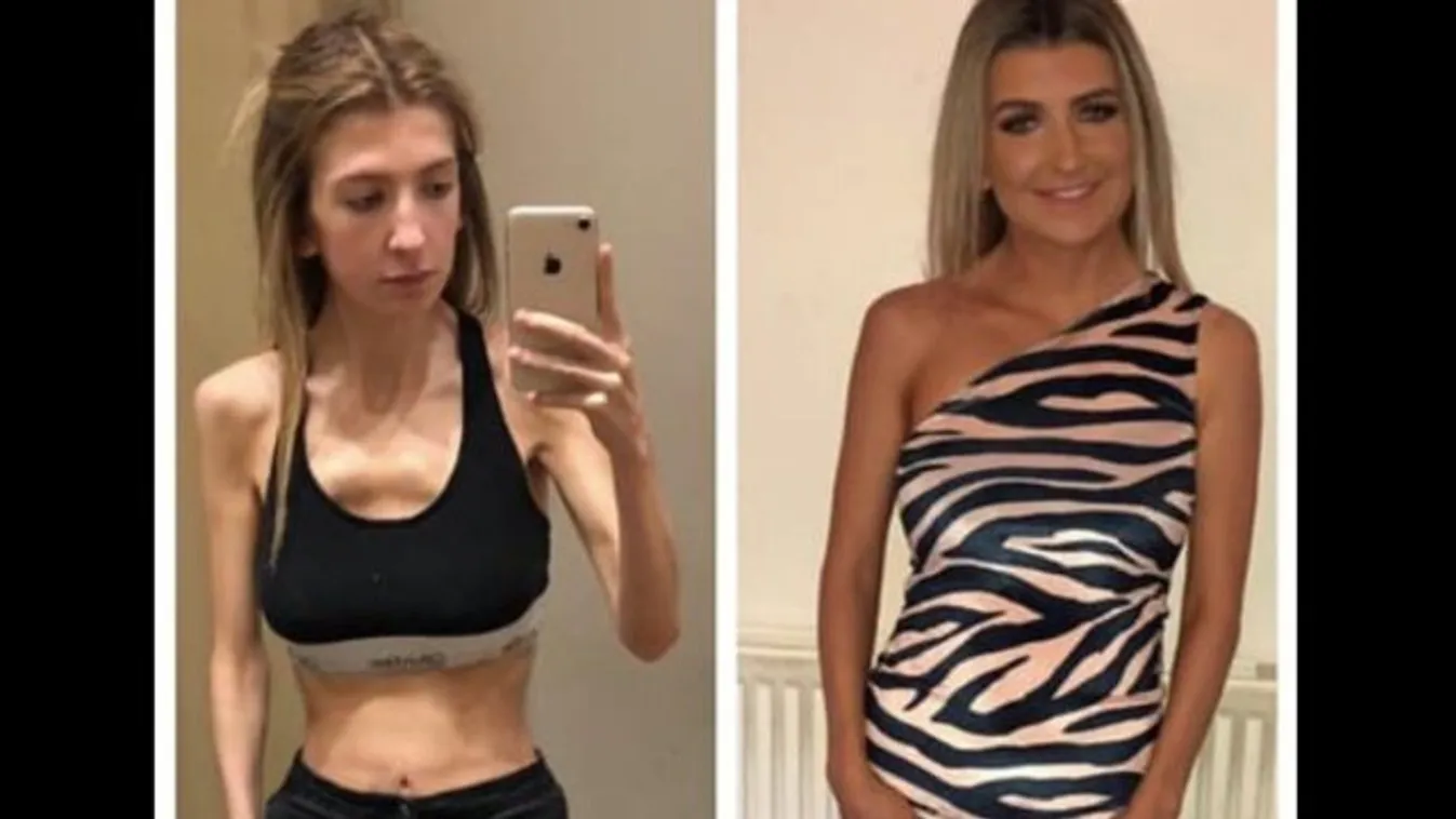 Micsoda átváltozás, anorexiás tiniből csinos, kivirult lány lett - és most mindenkit harcra buzdít!