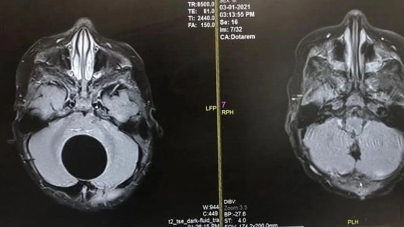 Fogakat és hajat is növesztett egy újszülött agyában terjedő tumor