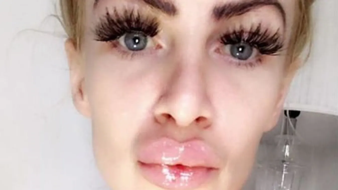 Botox helyett babaolajat fecskendezett a plasztikai sebész az élő barbie baba szájába