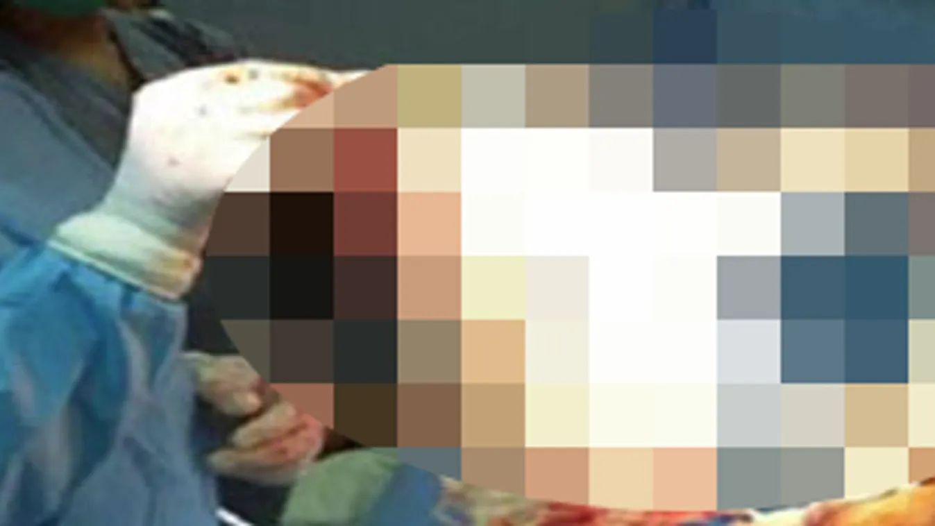 4 évig hordozta testében a hatalmas idegent