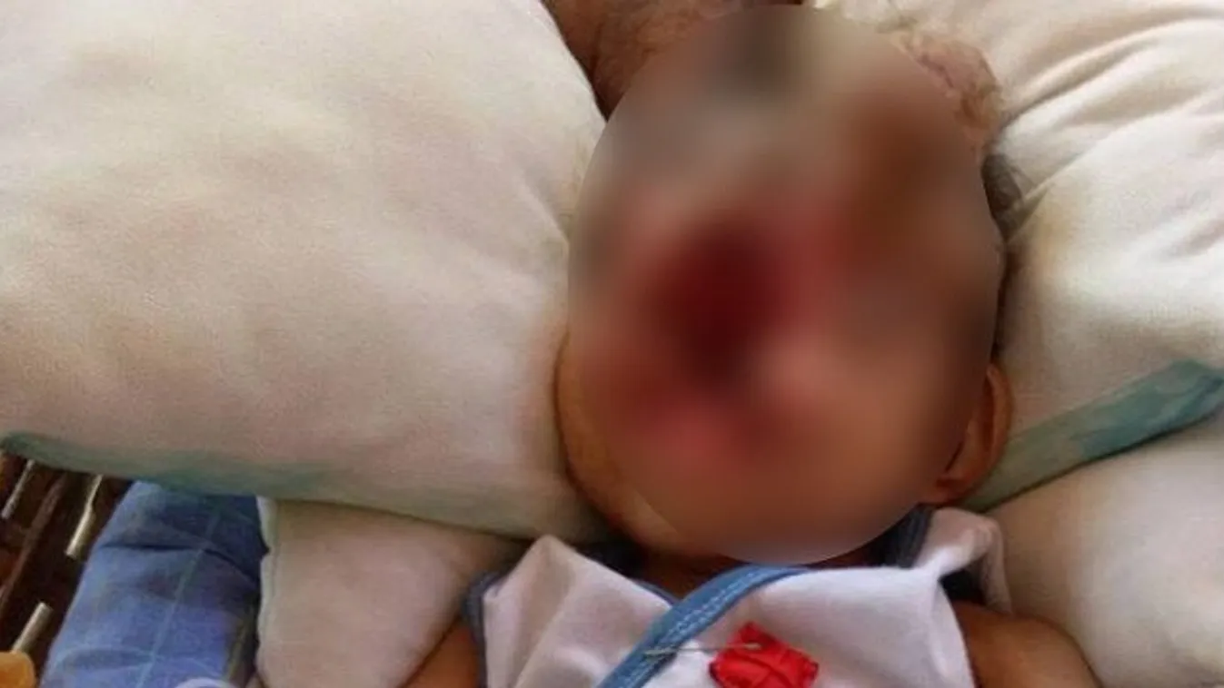 Első születésnapját ünnepli az arc nélkül született baba – 18+