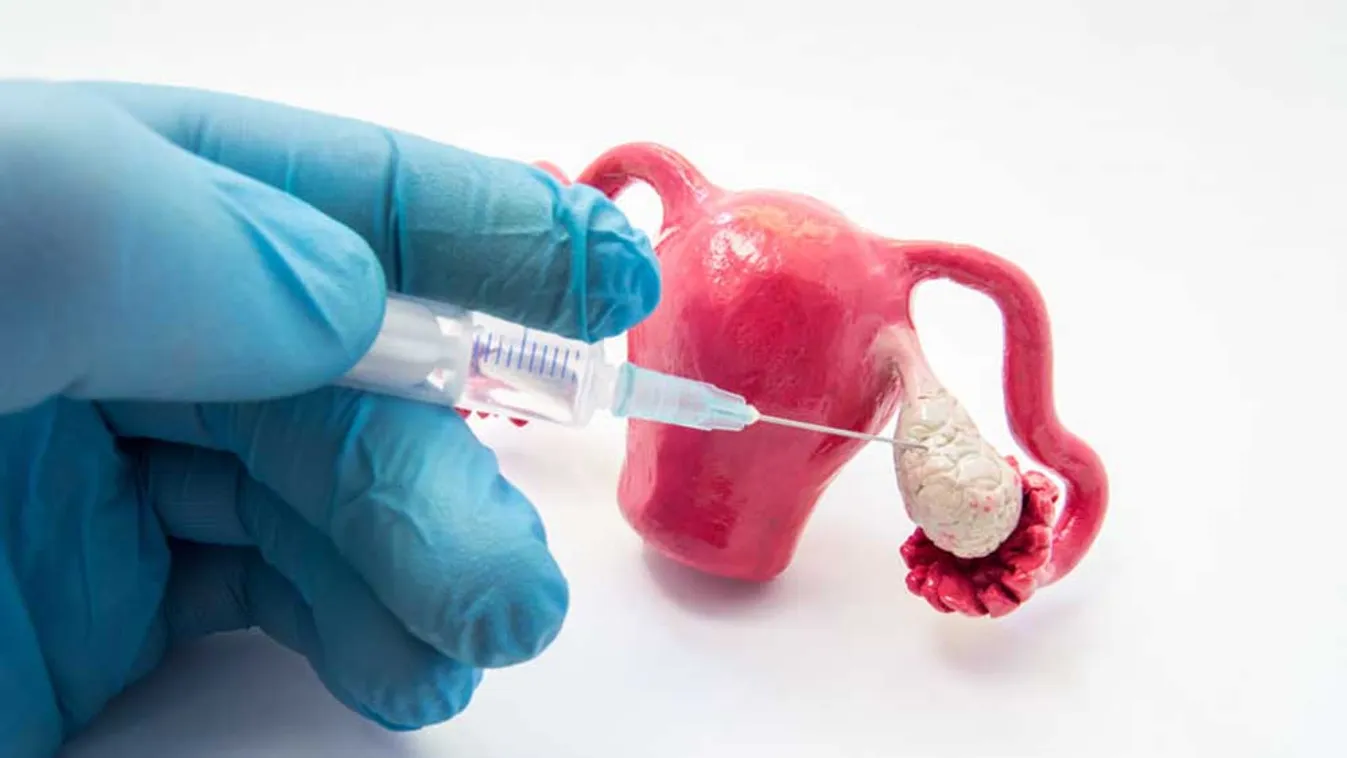 A perimenopauza és a PCOS tünetei könnyen összekeverhetőek