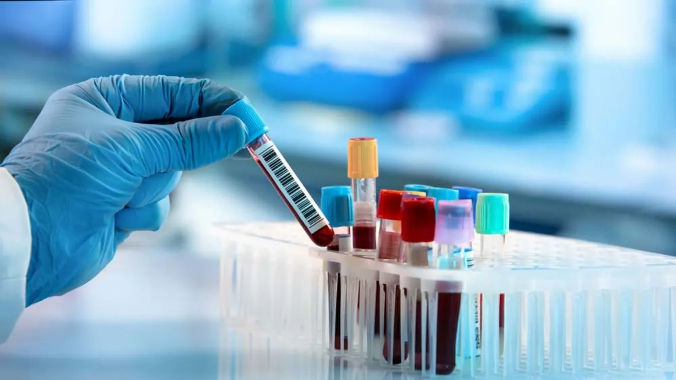 Mit mutat a ferritin szint a laboreredményben?