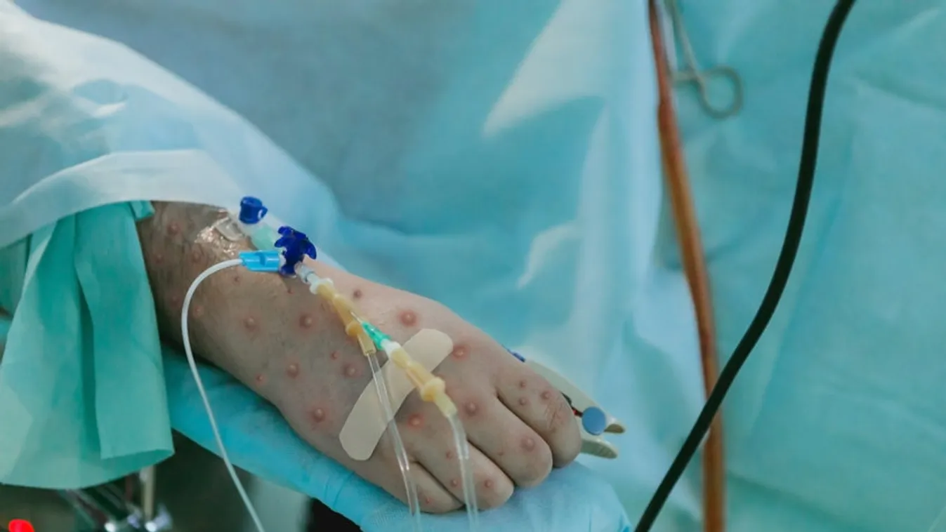 Majomhimlő – Meredeken emelkedik a betegek száma Magyarországon