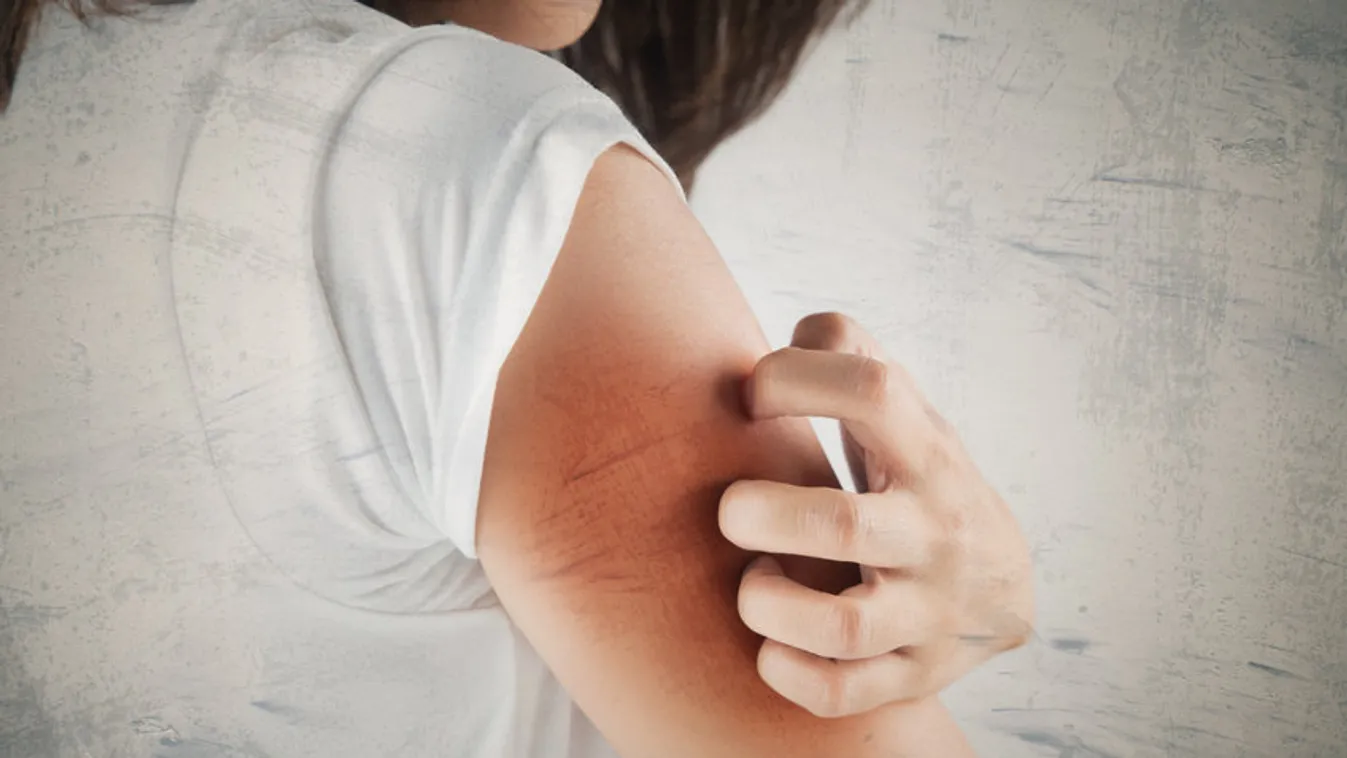 Életveszélyes allergiás reakció, nagyon megtévesztő tünetekkel