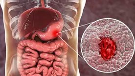 9 tudományosan alátámasztott otthoni gyógymód a gyomorfekély ellen