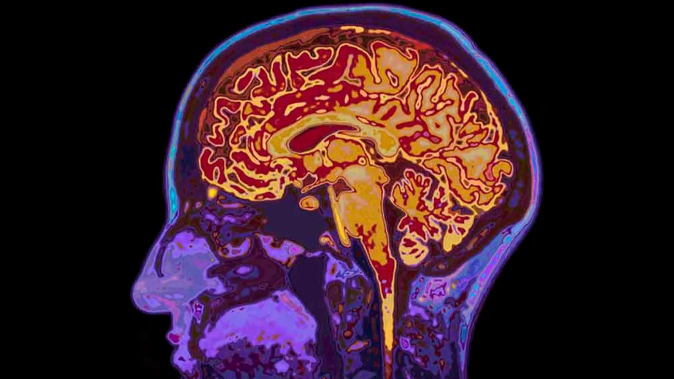 Áttörés az Alzheimer-kór kutatásában