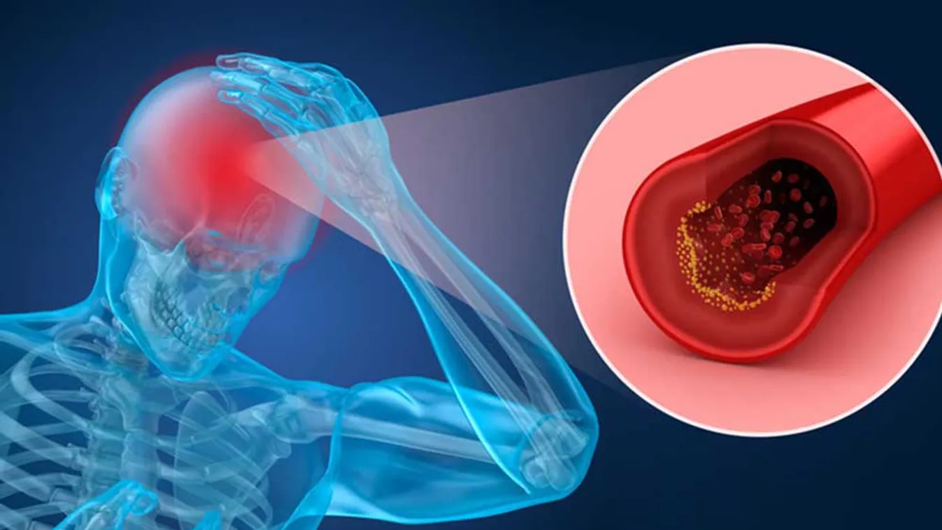 TIA, a stroke előhírnöke - Mi a teendő?