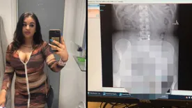 Kínos szexbaleset, beragadt vibrátor miatt kellett műteni a nőt