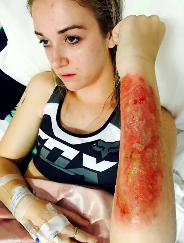 Jenna Allen, pókcsípés, Northfoto
